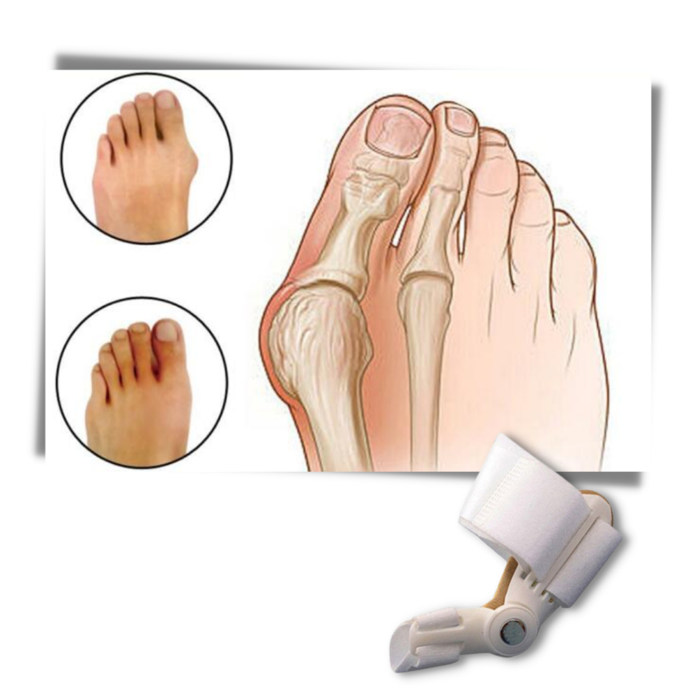 Ortopedisk hallux valgus korrigerer - Ozerty