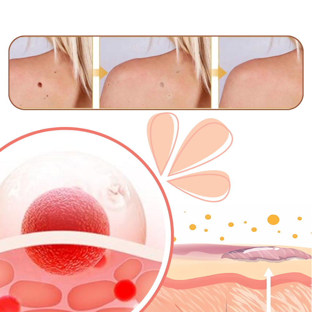 Ikke-Invasiv Fjerning av Merker - Ozerty