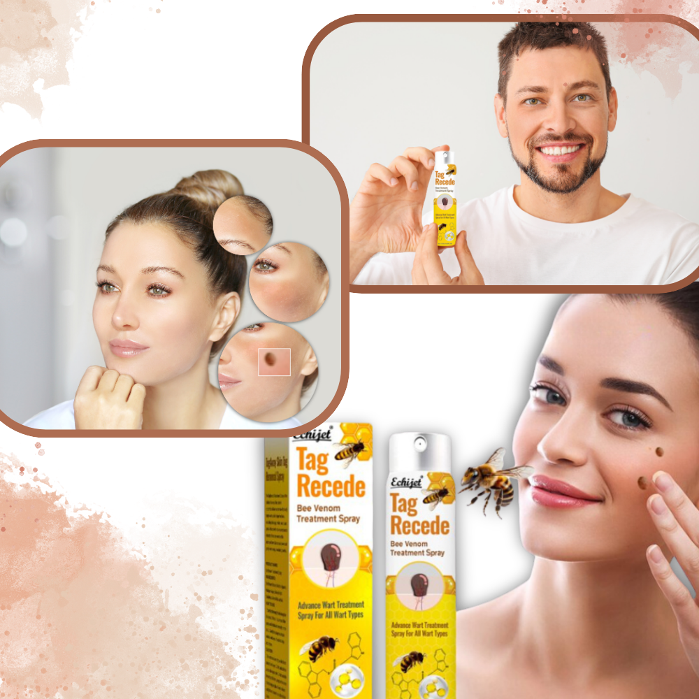 Ikke-Invasiv Fjerning av Merker - Ozerty