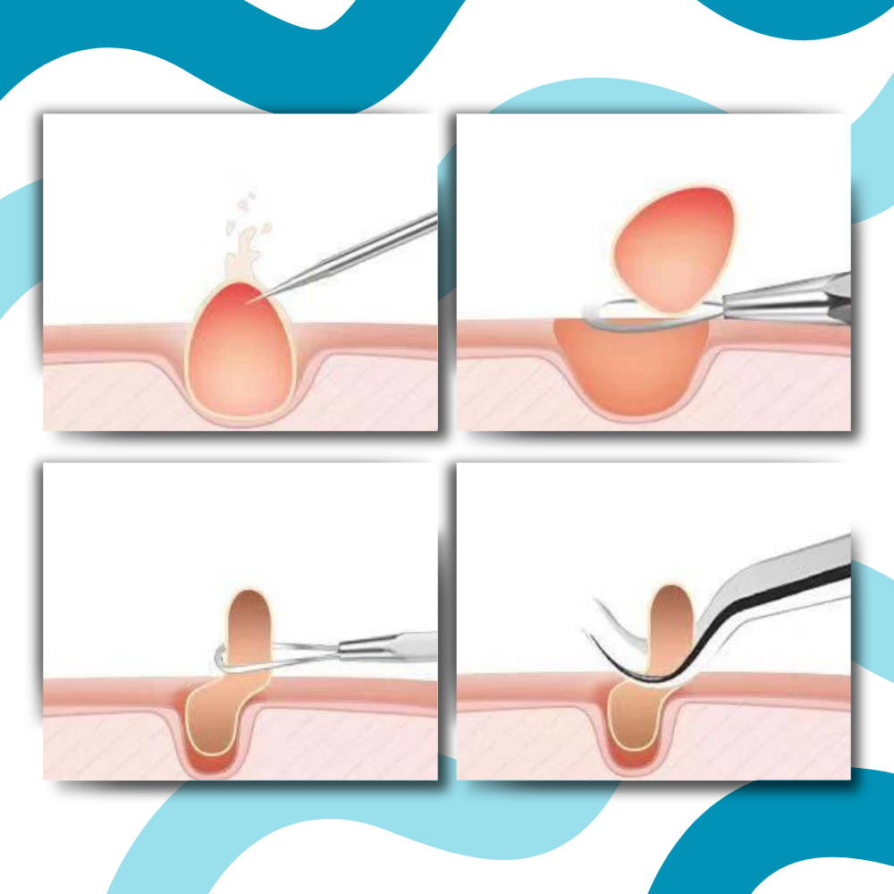 Ultrapresis spiss pinsett - Ozerty