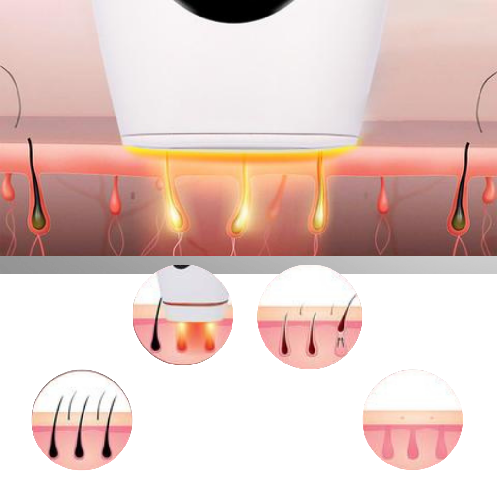 IPL laser hårfjerning apparat - Ozerty