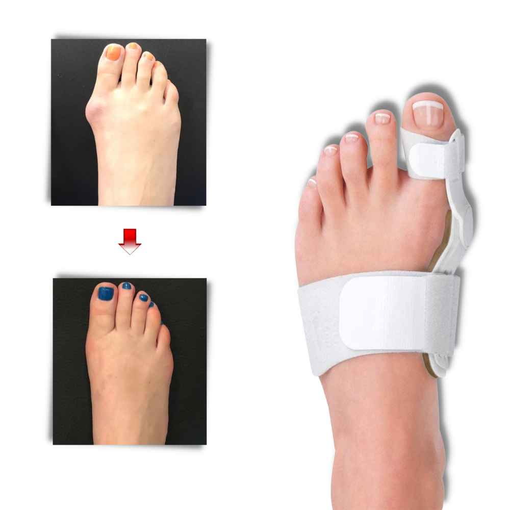 Ortopedisk hallux valgus korrigerer - Ozerty