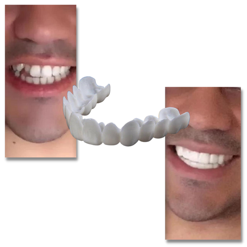 Perfekt smil tanndekning - komfortable finér - Onorge