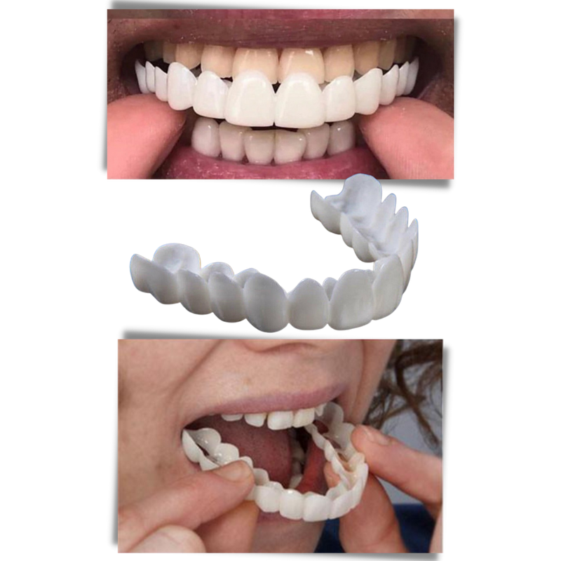 Perfekt smil tanndekning - komfortable finér - Onorge